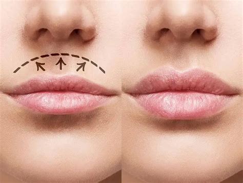 dudak kenarı düşüklüğü egzersizleri